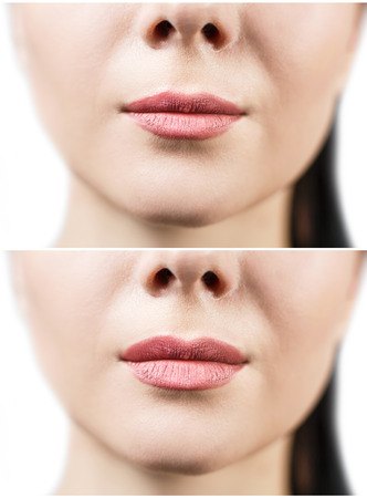 58945107 - before and after lip filler injections. fillers. lip augmentation over white background