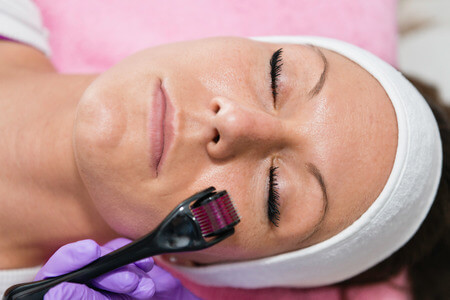 52981163 - dermaroller treatment in beauty salon