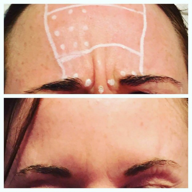 Botox UniSkin