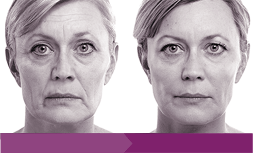 Cheek Enhancement Cheek Enhancement