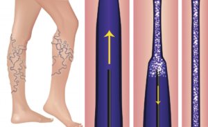 sclerotherapy treatment Belper